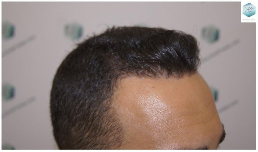 Injerto Capilar Técnica FUE 3018 Grafts (6498 Pelos) 30 ANTES-Y-DESPUES-TRASPLANTE-CAPILAR-CASO