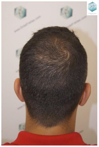Injerto Capilar Técnica FUE 3018 Grafts (6498 Pelos) 33 ANTES-Y-DESPUES-TRASPLANTE-CAPILAR-CASO