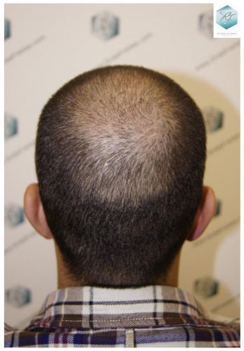 Injerto Capilar Técnica FUE 3018 Grafts (6498 Pelos) 25 ANTES-Y-DESPUES-TRASPLANTE-CAPILAR-CASO