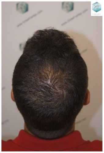 Injerto Capilar Técnica FUE 3018 Grafts (6498 Pelos) 32 ANTES-Y-DESPUES-TRASPLANTE-CAPILAR-CASO