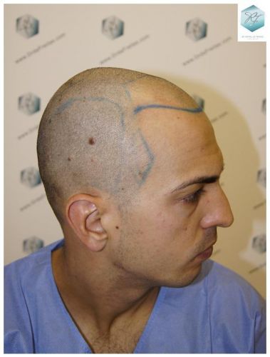 Injerto Capilar Técnica FUE 3018 Grafts (6498 Pelos) 10 TRASPLANTE CAPILAR