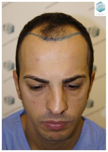 DISEÑO LÍNEA INJERTO CAPILAR TRASPLANTE CAPILAR