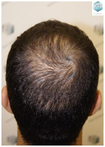 Injerto Capilar Técnica FUE 3018 Grafts (6498 Pelos) 35 TRASPLANTE CAPILAR