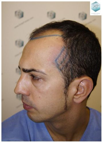 Injerto Capilar Técnica FUE 3018 Grafts (6498 Pelos) 5 TRASPLANTE CAPILAR