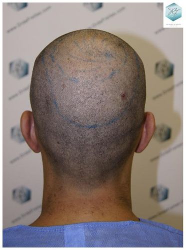 Injerto Capilar Técnica FUE 3018 Grafts (6498 Pelos) 12 TRASPLANTE CAPILAR