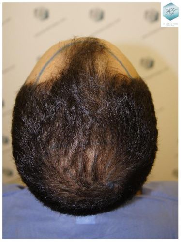 Injerto Capilar Técnica FUE 3018 Grafts (6498 Pelos) 34 TRASPLANTE CAPILAR