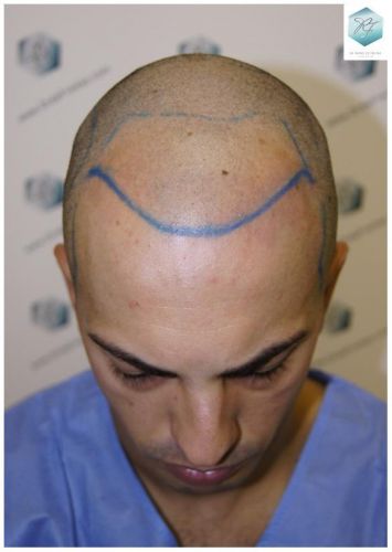 Injerto Capilar Técnica FUE 3018 Grafts (6498 Pelos) 7 TRASPLANTE CAPILAR