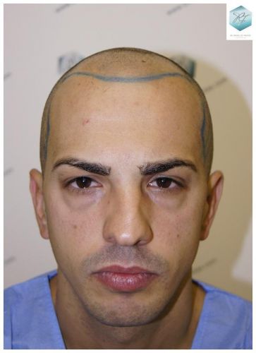 Injerto Capilar Técnica FUE 3018 Grafts (6498 Pelos) 6 TRASPLANTE CAPILAR