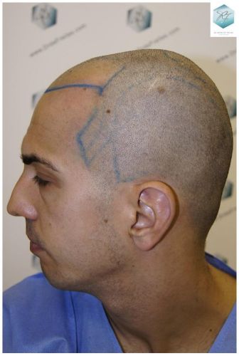 Injerto Capilar Técnica FUE 3018 Grafts (6498 Pelos) 11 TRASPLANTE CAPILAR