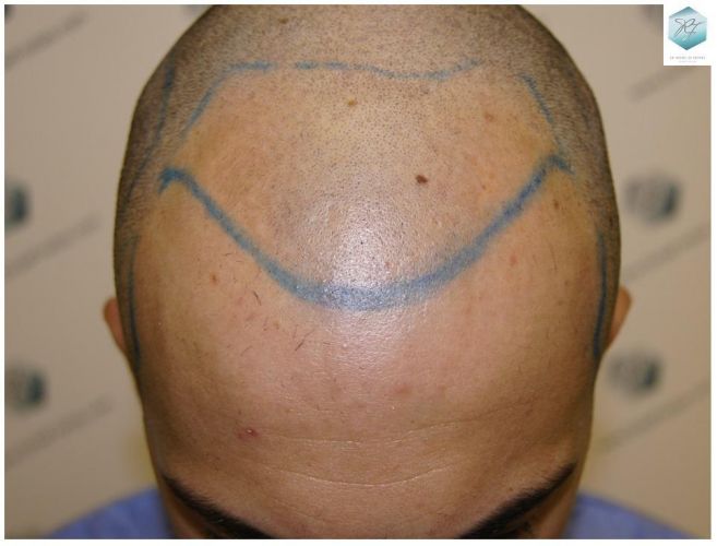 Injerto Capilar Técnica FUE 3018 Grafts (6498 Pelos) 9 TRASPLANTE CAPILAR