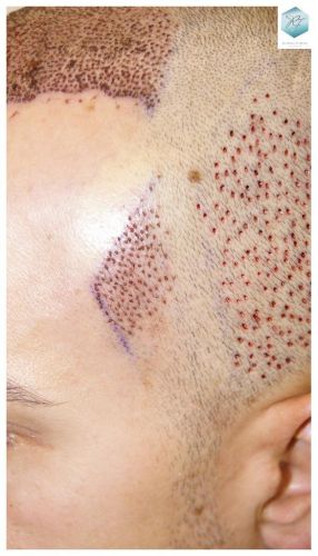 Injerto Capilar Técnica FUE 3018 Grafts (6498 Pelos) 17 TRASPLANTE CAPILAR