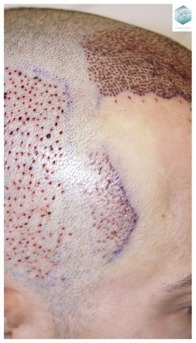 Injerto Capilar Técnica FUE 3018 Grafts (6498 Pelos) 16 TRASPLANTE CAPILAR