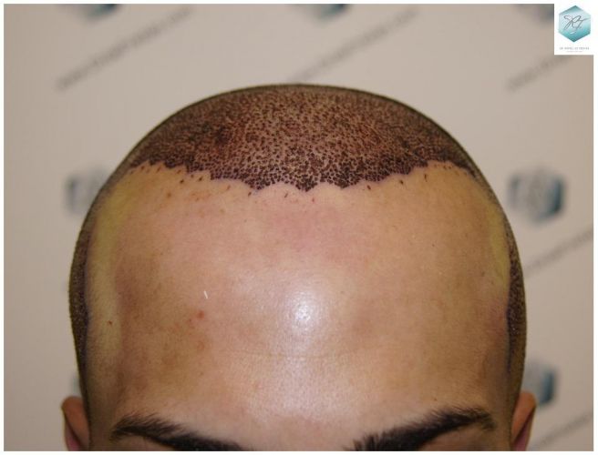 Injerto Capilar Técnica FUE 3018 Grafts (6498 Pelos) 13 TRASPLANTE CAPILAR