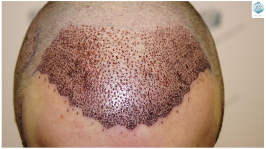 Injerto Capilar Técnica FUE 3018 Grafts (6498 Pelos) 14 TRASPLANTE CAPILAR