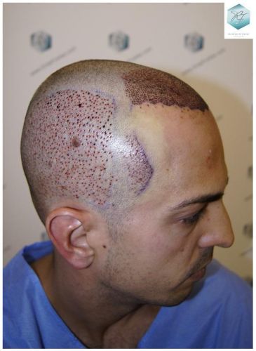 Injerto Capilar Técnica FUE 3018 Grafts (6498 Pelos) 15 TRASPLANTE CAPILAR