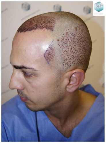 Injerto Capilar Técnica FUE 3018 Grafts (6498 Pelos) 18 TRASPLANTE CAPILAR