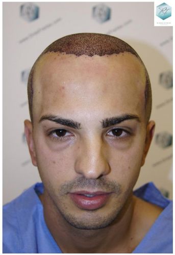 TRASPLANTE CAPILAR IMPLANTE CAPILAR