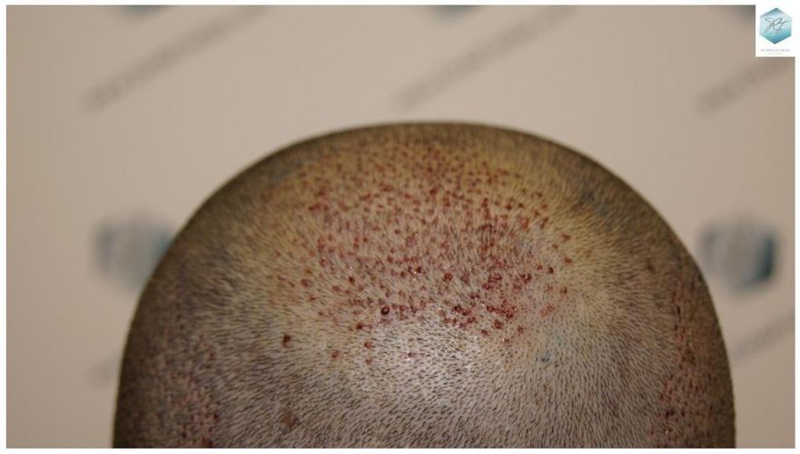 Injerto Capilar Técnica FUE 3018 Grafts (6498 Pelos) 19 IMPLANTE CAPILAR