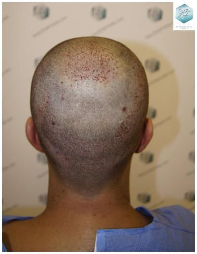 Injerto Capilar Técnica FUE 3018 Grafts (6498 Pelos) 20 IMPLANTE CAPILAR