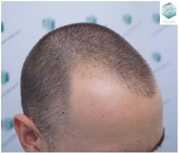 Injerto Capilar Técnica FUE Grafts 2423 (6189 Pelos) 2 implante de pelo