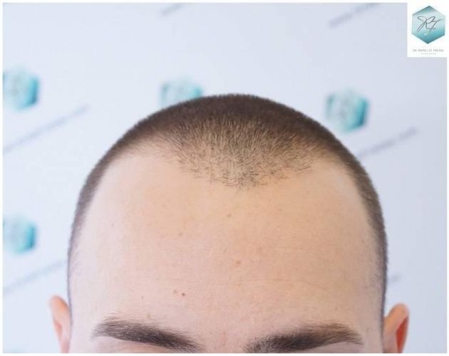 ANTES DEL TRASPLANTE CAPILAR implante de pelo