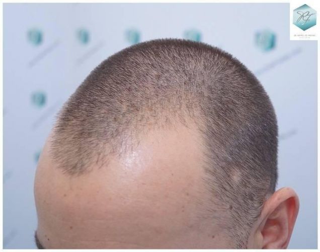 Injerto Capilar Técnica FUE Grafts 2423 (6189 Pelos) 3 implante de pelo