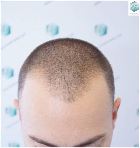 Injerto Capilar Técnica FUE Grafts 2423 (6189 Pelos) 1 implante de pelo
