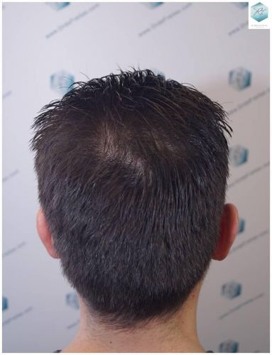 Injerto Capilar Técnica FUE Grafts 2423 (6189 Pelos) 31 injerto capilar resultados