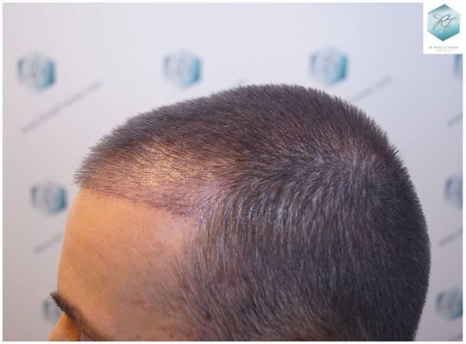 Injerto Capilar Técnica FUE Grafts 2423 (6189 Pelos) 14 trasplante de pelo valencia