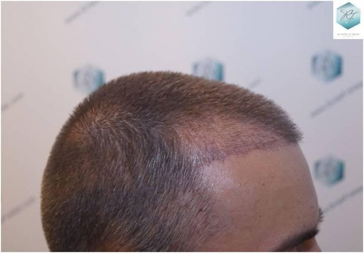 Injerto Capilar Técnica FUE Grafts 2423 (6189 Pelos) 13 trasplante de pelo valencia