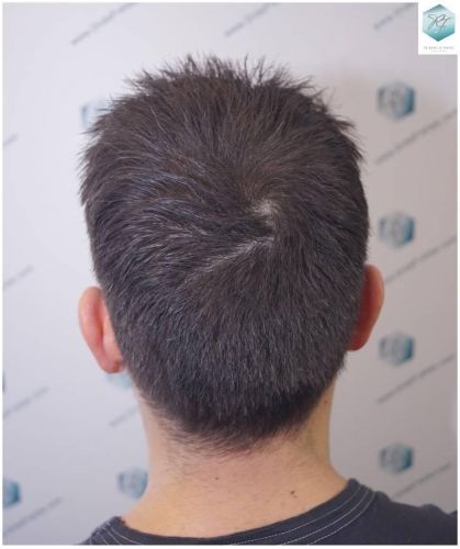 Injerto Capilar Técnica FUE Grafts 2423 (6189 Pelos) 29 trasplante de pelo valencia