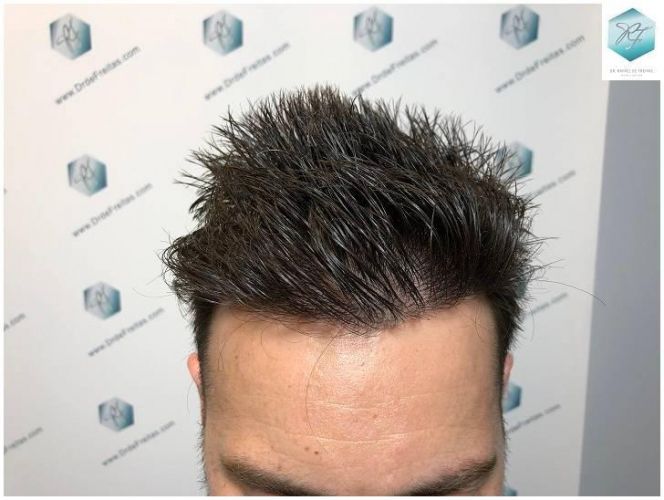 Injerto Capilar Técnica FUE Grafts 2423 (6189 Pelos) 21 trasplante de pelo valencia