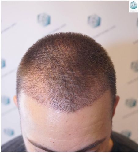 Injerto Capilar Técnica FUE Grafts 2423 (6189 Pelos) 12 trasplante de pelo valencia