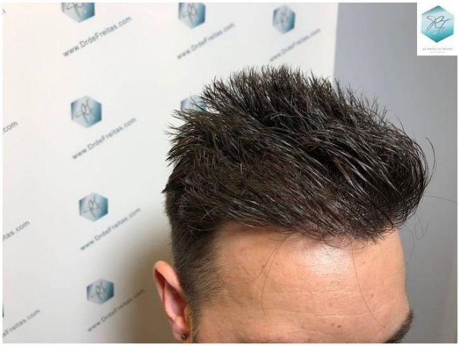 Injerto Capilar Técnica FUE Grafts 2423 (6189 Pelos) 22 trasplante de pelo valencia