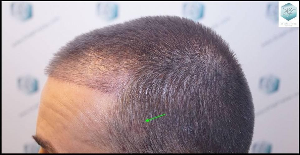 Injerto Capilar Técnica FUE Grafts 2423 (6189 Pelos) 15 trasplante de pelo valencia