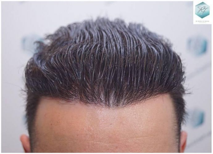Injerto Capilar Técnica FUE Grafts 2423 (6189 Pelos) 19 trasplante de pelo valencia