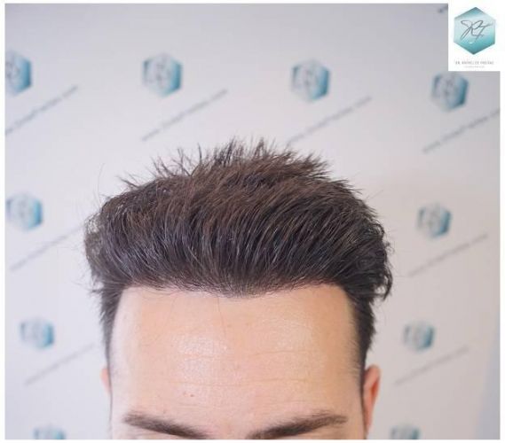 Injerto Capilar Técnica FUE Grafts 2423 (6189 Pelos) 20 trasplante de pelo valencia