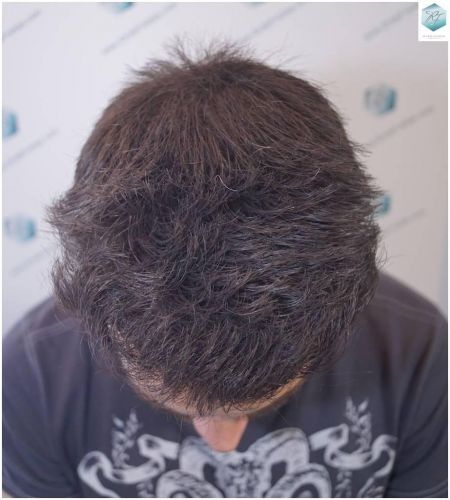 Injerto Capilar Técnica FUE Grafts 2423 (6189 Pelos) 18 trasplante de pelo valencia