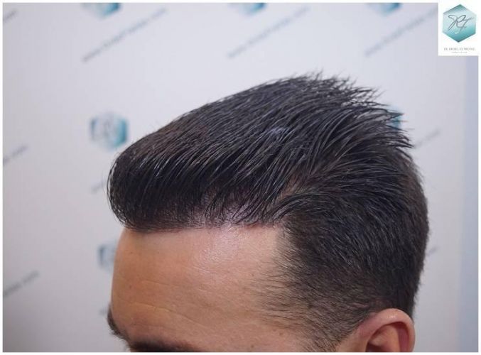 Injerto Capilar Técnica FUE Grafts 2423 (6189 Pelos) 25 injerto capilar resultados