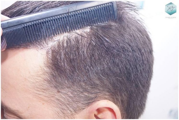 Injerto Capilar Técnica FUE Grafts 2423 (6189 Pelos) 27 comparativa injerto capilar
