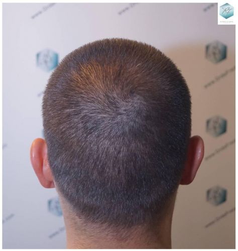 Injerto Capilar Técnica FUE Grafts 2423 (6189 Pelos) 16 injerto capilar resultados