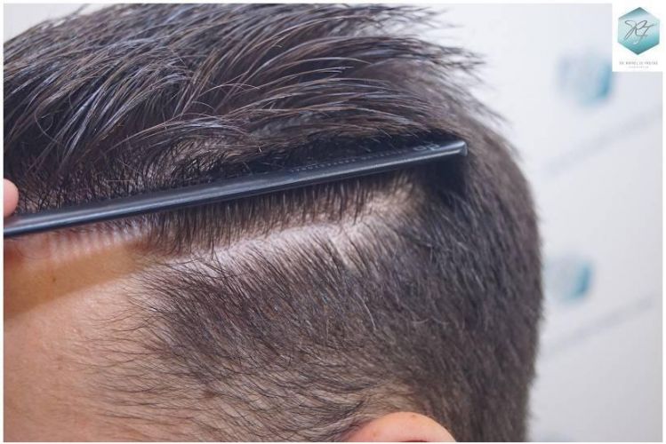 Injerto Capilar Técnica FUE Grafts 2423 (6189 Pelos) 28 trasplante de pelo valencia