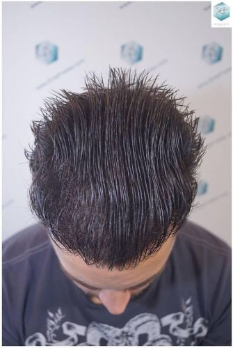 Injerto Capilar Técnica FUE Grafts 2423 (6189 Pelos) 24 trasplante de pelo valencia