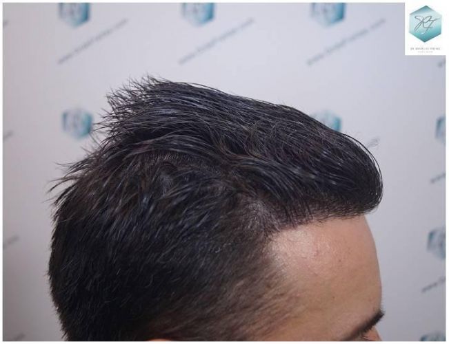 Injerto Capilar Técnica FUE Grafts 2423 (6189 Pelos) 23 trasplante de pelo valencia