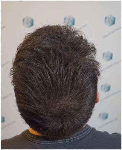 Injerto Capilar Técnica FUE Grafts 2423 (6189 Pelos) 30 trasplante de pelo valencia