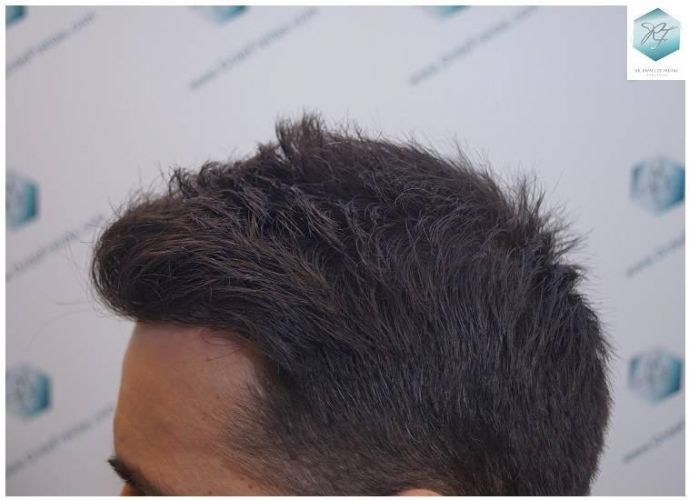 Injerto Capilar Técnica FUE Grafts 2423 (6189 Pelos) 26 trasplante de pelo valencia