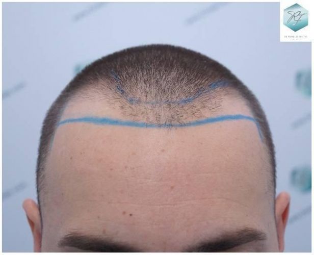 DISEÑO LÍNEA INJERTO CAPILAR implante de pelo