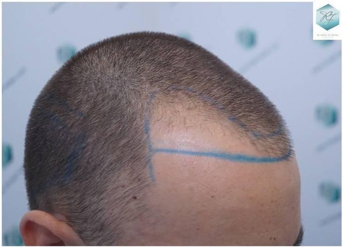 Injerto Capilar Técnica FUE Grafts 2423 (6189 Pelos) 5 implante de pelo