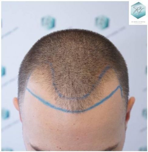 Injerto Capilar Técnica FUE Grafts 2423 (6189 Pelos) 4 implante de pelo