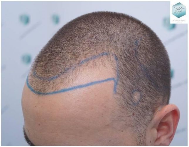 Injerto Capilar Técnica FUE Grafts 2423 (6189 Pelos) 6 implante de pelo